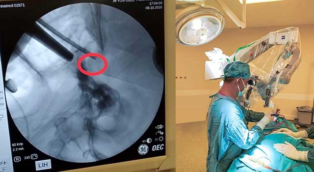 Afyonkarahisar’da 72 Yaşındaki Hastanın Beynindeki Tümörü Burnundan Çıkarttılar