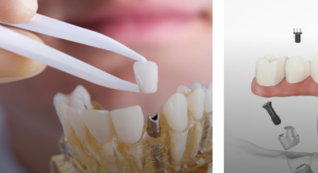 İzmir Diş Tedavilerini Seçmek