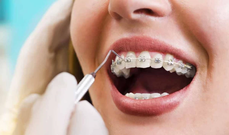 Ortodontide Sık Sorulanlar