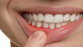Diş Eti Tedavisi İçin Öneriler