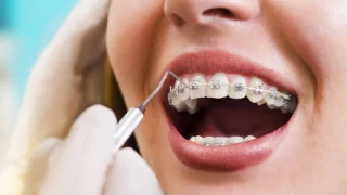 Ortodontide Sık Sorulanlar