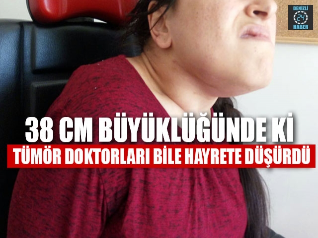 Denizli'de 38 Cm Büyüklüğünde Ki Tümör