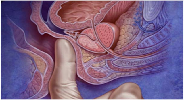 Prostat Tedavisi Bitkisel