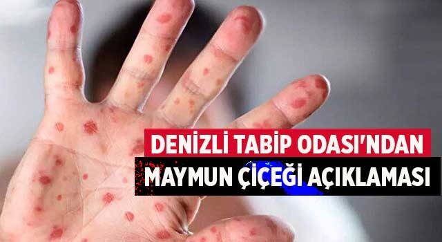 Denizli Tabip Odası'ndan Maymun Çiçeği açıklaması