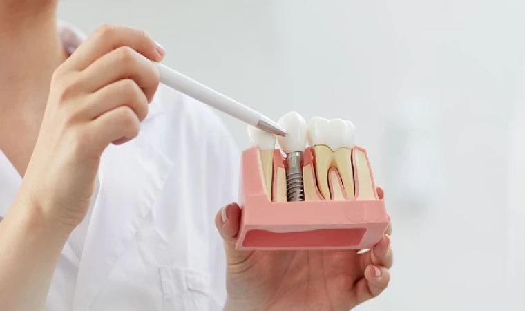 Uzman Doktor Emrah Anbarcıoğlu ile En Uygun İmplant Tedavisi