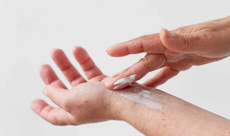 Yanık Dereceleri ve Anlamları: Hangi Yanık Türü Ne İfade Eder?