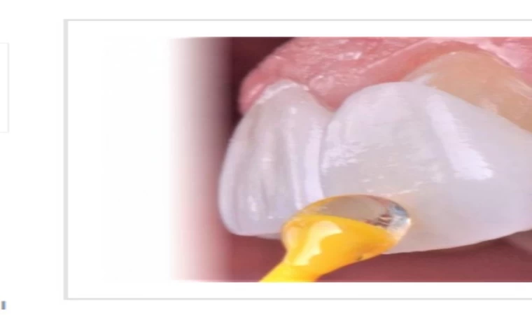 Antalya’da porselen lamine diş kaplama