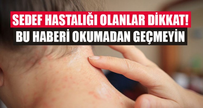 Sedef Hastalığı Olanlar Dikkat!